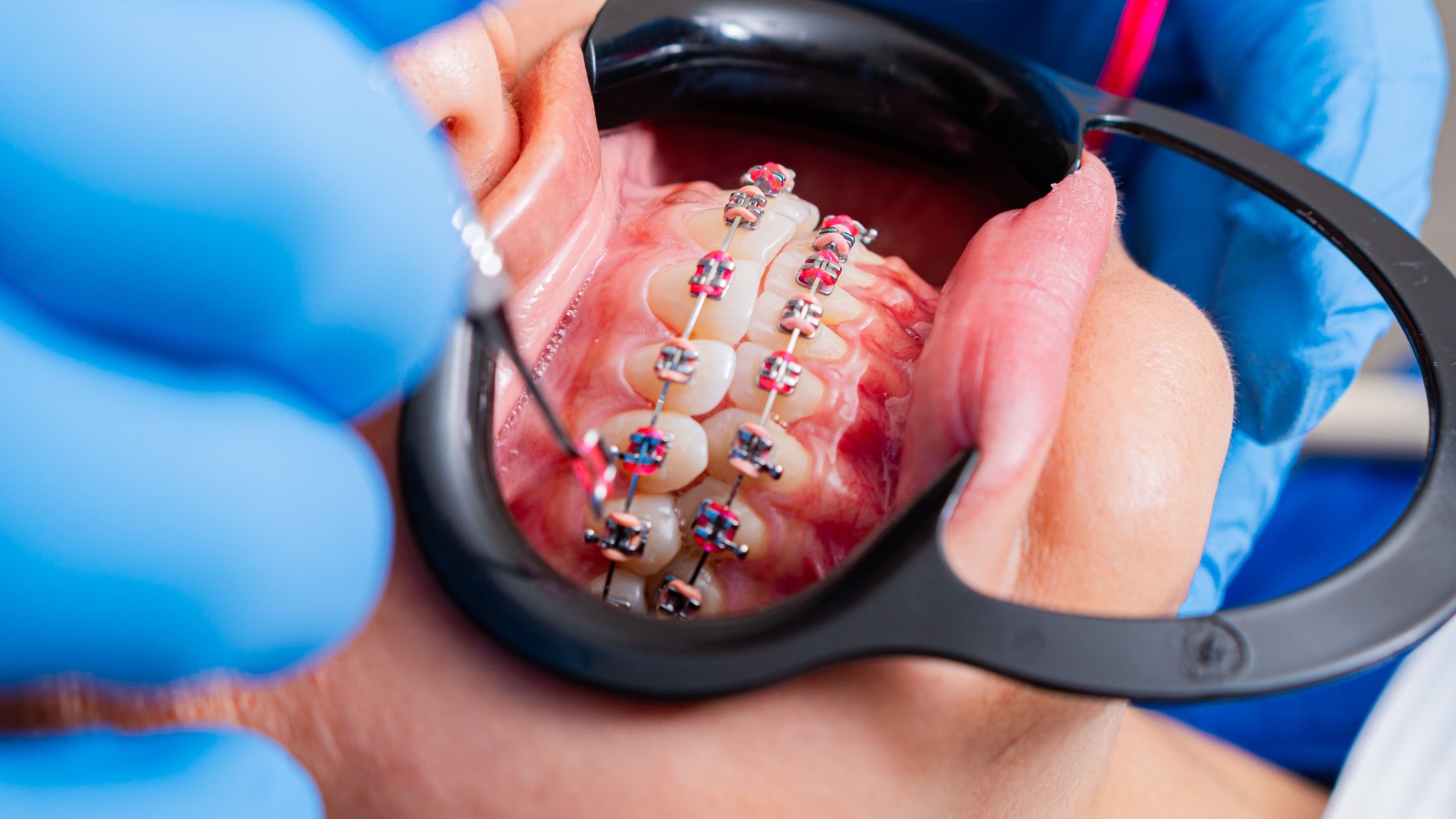 Close-up of orthodontic clear aligners